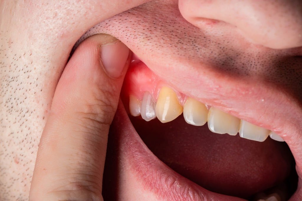 How Long Can You Keep Your Teeth with Periodontal Disease