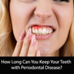 How Long Can You Keep Your Teeth with Periodontal Disease