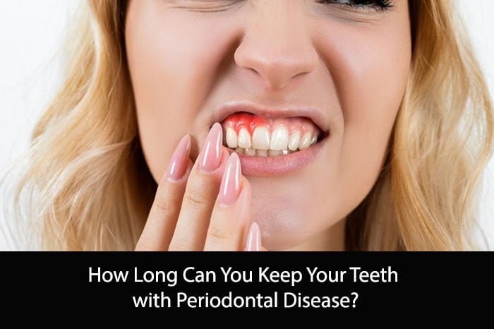 How Long Can You Keep Your Teeth with Periodontal Disease?