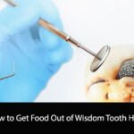 How to Get Food Out of Wisdom Tooth Hole